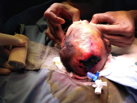 Aplasia cutis, Firoz bal Surgery in Shri Vatsalya Hospital
