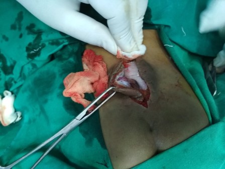Meningomyelocele Surgery in Shri Vatsalya Hospital