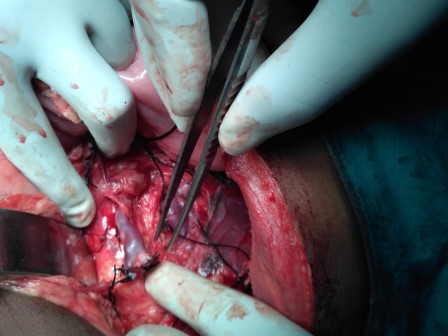 SplenorenalSurgery in Shri Vatsalya Hospital